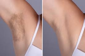 Underarms